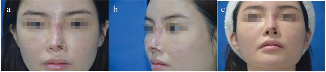 自身脂肪移植隆鼻手术并发症研究