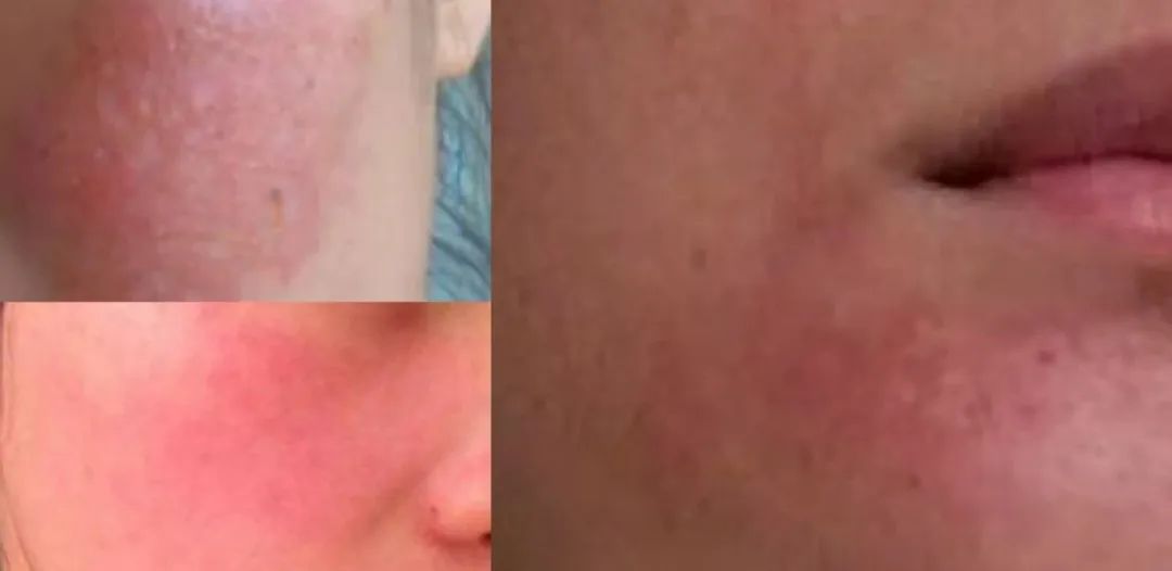 麻膏/麻贴过敏灼伤处理方法以及如何避免