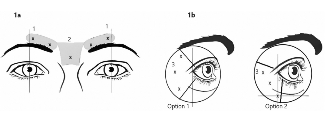 肉毒素眶周新打法来了：起效更快，剂量更少