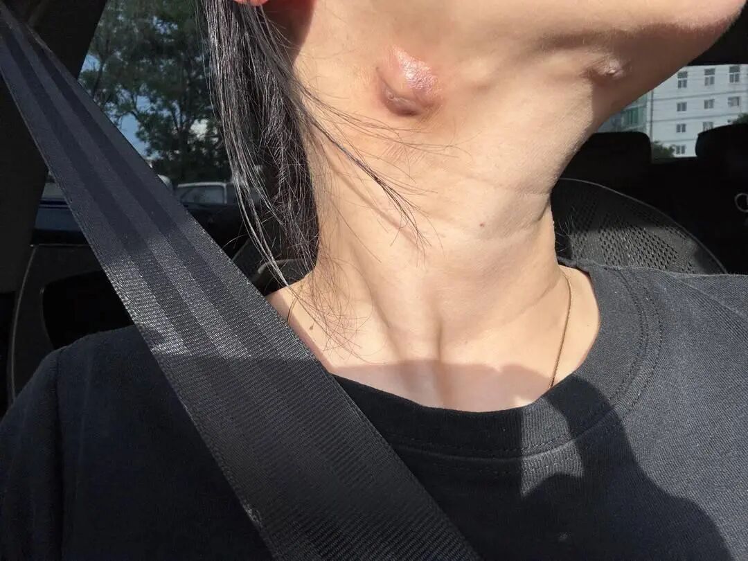 本想瘦双下巴，结果长7个硬块溃烂！打针者失联，卫健部门立案无下文