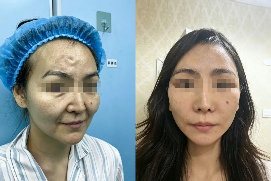 干了快30年的整形医生，说句掏心窝子的话：医美真别做太勤…